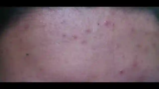 summer-skin-woes-distinguishing-heat-rash-from-acne