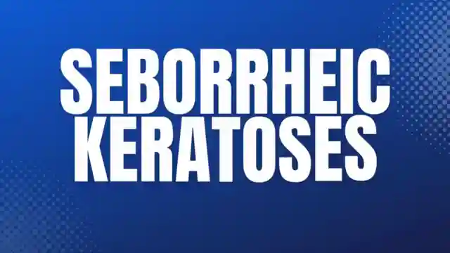 effective-treatments-for-seborrheic-keratosis-expert-advice